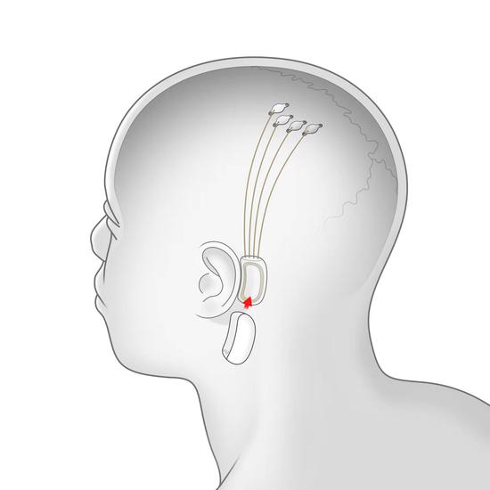 马斯克发布脑机接口系统：激光开颅放置，芯片直连大脑