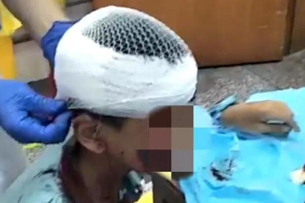 男孩遭宠物犬撕咬：长沙10岁男孩遭无人看管的宠物狗撕咬，头部多处受伤